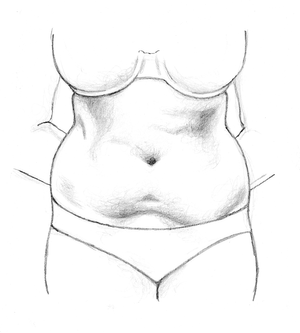 Before Liposuction Surgery