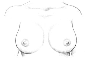 After Breast Implant Revision Surgery